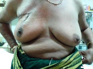 Breast conserving surgery